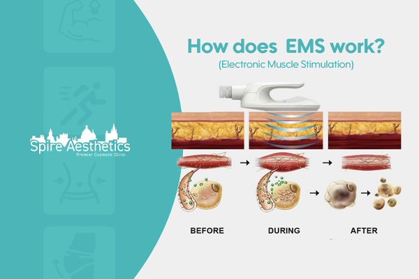 EMS treatment for post pregnancy weight loss treatment Grays