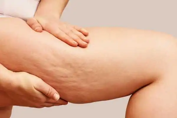 Image of woman showing leg with cellulite Grays