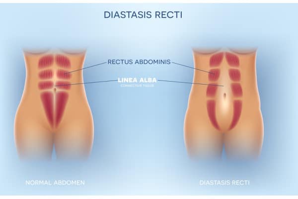 What Non-Surgical Options Are Available for Diastasis Recti Grays?