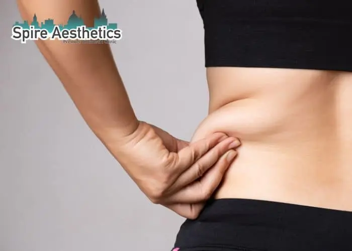 Image of woman pinching fat on their hips Grays. Fat Freezing treatment
