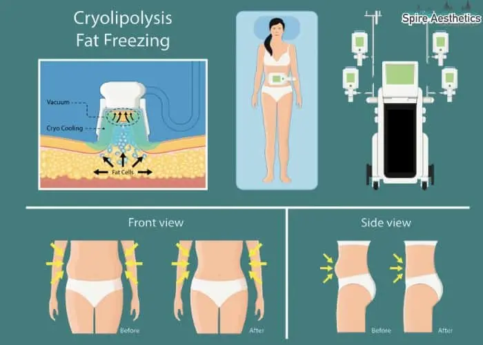 Fat freezing treatment Grays benefits for competitions to remove stubborn fat deposits.
