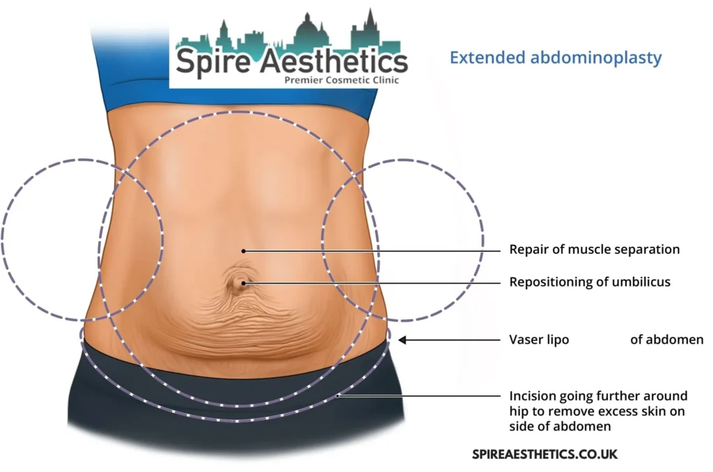 Understanding Loose Skin After Gastric Band Grays Surgery and HIFU Treatment
