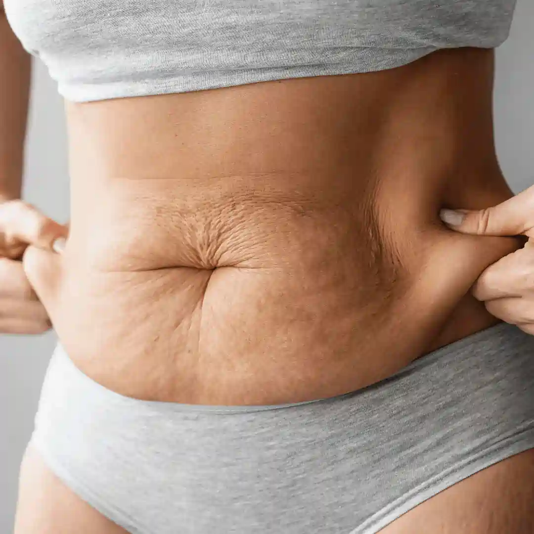 Is It Normal to Have Loose Skin After Pregnancy Grays?
