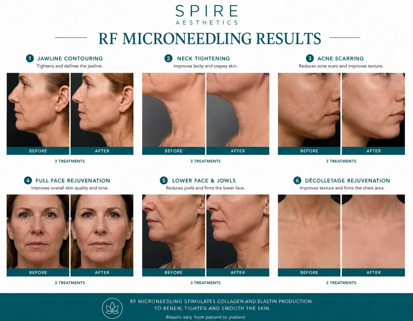 RF Microneedling Skin tightening Grays results