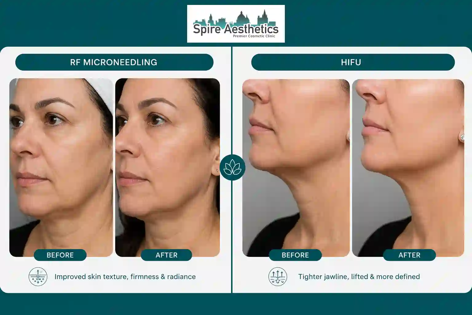 Can RF Microneedling and HIFU Be Combined Grays?