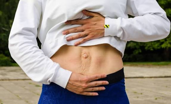 When Could Diastasis Recti Be the Missing Piece of the Puzzle Grays?